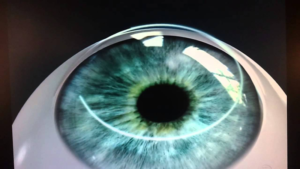 Cong Nghe Presby Max Dieu Tri Lao Thi Ket Hop Cac Tat Khuc Xa Khac