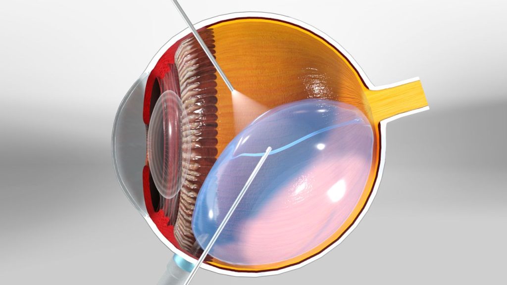 Phẫu Thuật Cắt Dịch Kính Võng Mạc