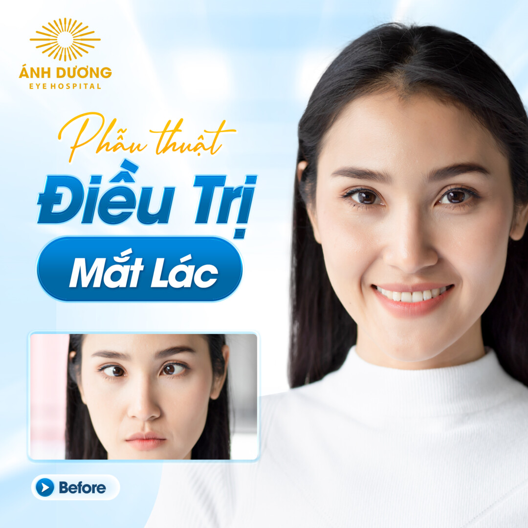 Phẫu Thuật Mắt Lé – Giải Pháp Điều Trị Hiệu Quả Cho Mọi Độ Tuổi