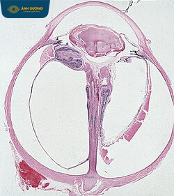 Cắt dịch kính điều trị tồn lưu dịch kính thủy nguyên