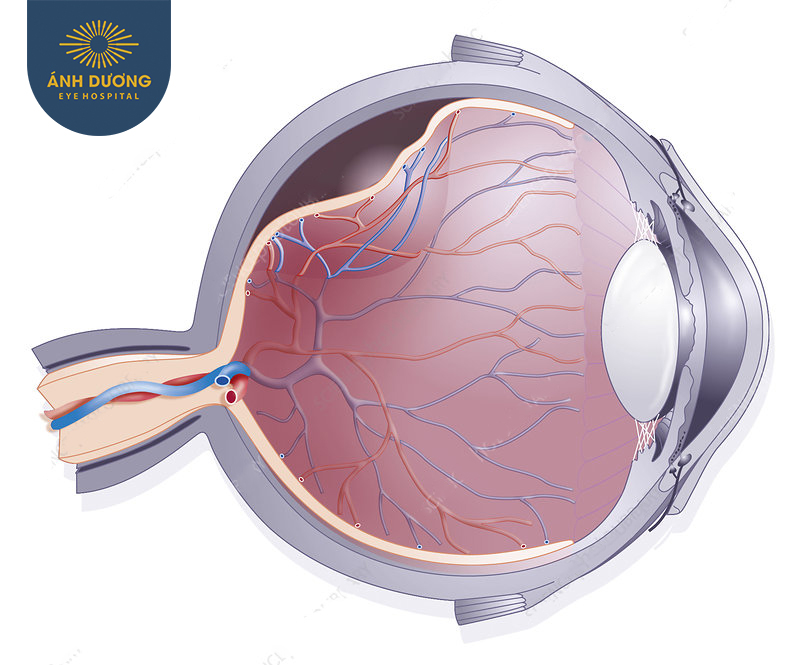 Phẫu thuật điều trị bong hắc mạc – Giải pháp cứu vãn thị lực kịp thời