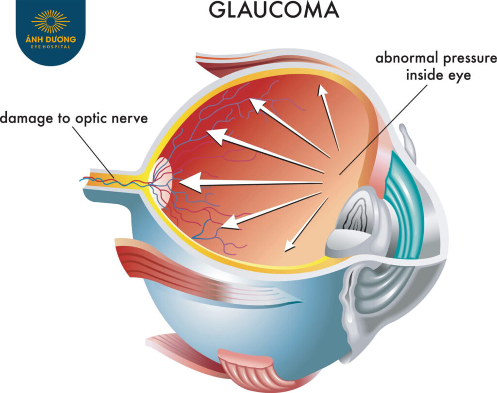 Phẫu Thuật Mở Góc Tiền Phòng