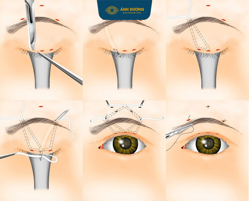 Phẫu thuật rút ngắn cơ nâng mi: Giải pháp hiệu quả khắc phục sụp mí