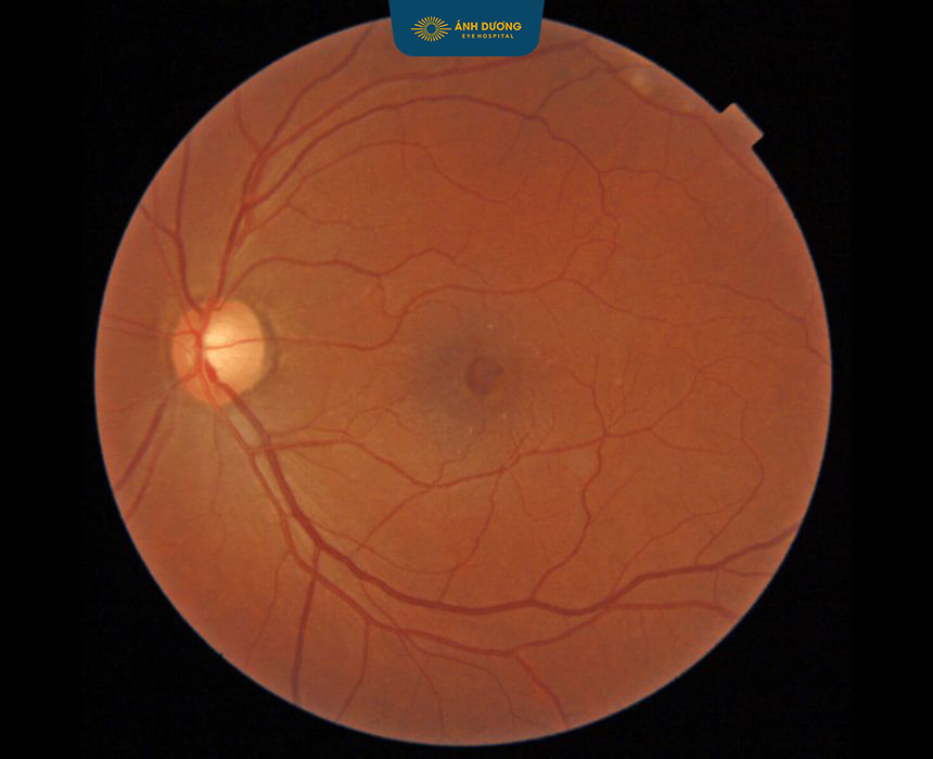Cắt dịch kính bóc màng trước võng mạc – Giải pháp phục hồi thị lực