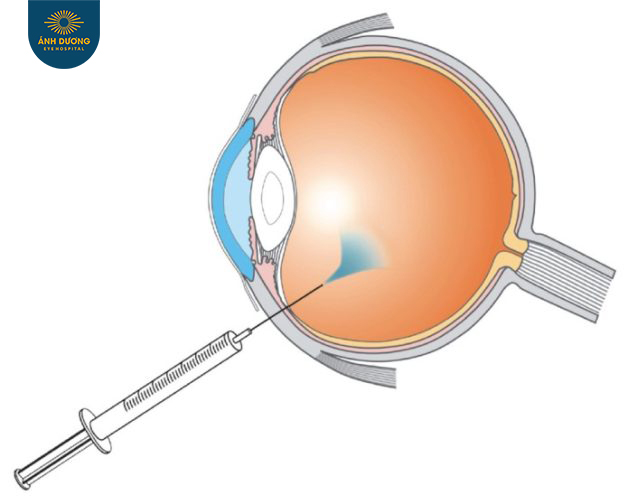 Bơm khí nội nhãn – Phương pháp điều trị quan trọng trong bệnh lý võng m
