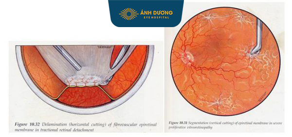 Cắt dịch kính điều trị viêm mủ nội nhãn – Giải pháp cứu thị lực khẩn cấp