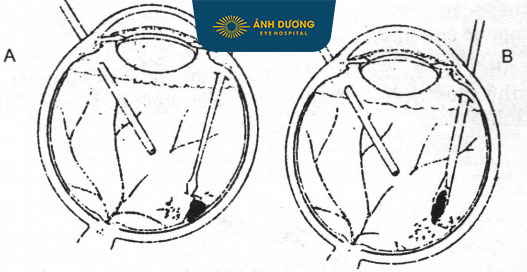 Cắt dịch kính và lấy dị vật nội nhãn