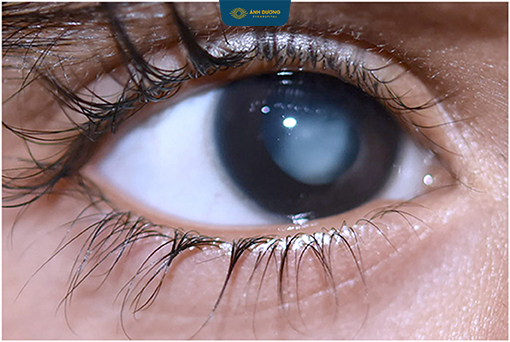 Cắt dịch kính điều trị tồn lưu dịch kính thủy nguyên