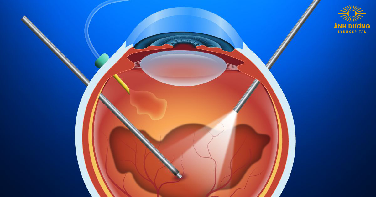 Cắt dịch kính có laser nội nhãn – Phương pháp điều trị hiệu quả cho bệnh lý võng mạc