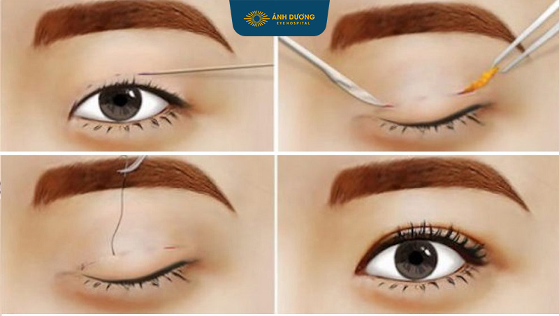 Phẫu thuật cắt da mi thừa – Giải pháp trẻ hóa đôi mắt hiệu quả