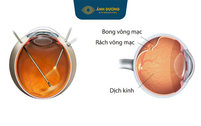 Phẫu thuật bong võng mạc – Cứu lấy ánh sáng cho đôi mắt