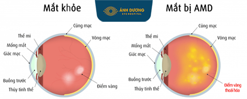 Phẫu thuật cắt bè củng mạc – Giải pháp điều trị glôcôm hiệu quả