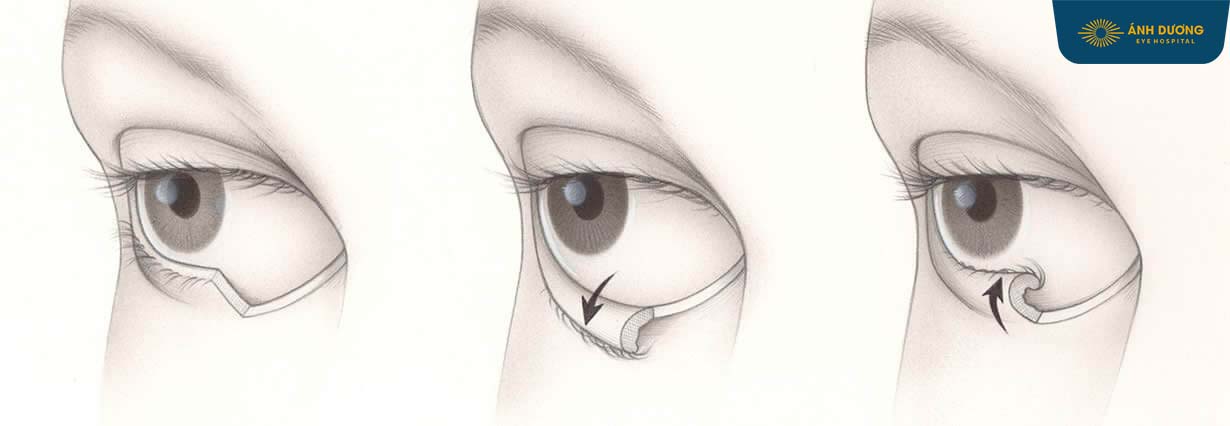 Phẫu thuật mộng/quặm: Giải pháp an toàn giúp bảo vệ đôi mắt sáng khỏe