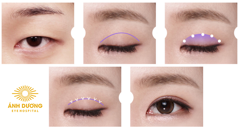 Tạo mắt 2 mí – Giải pháp cho đôi mắt to, đẹp và hài hòa