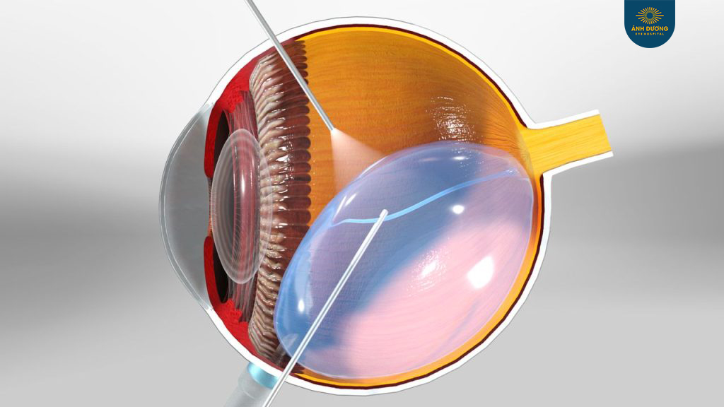 Cắt dịch kính không laser nội nhãn – Khi nào cần thực hiện?