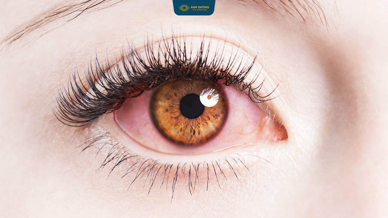 Bệnh giác mạc mắt – Nguyên nhân, triệu chứng và cách điều trị hiệu quả