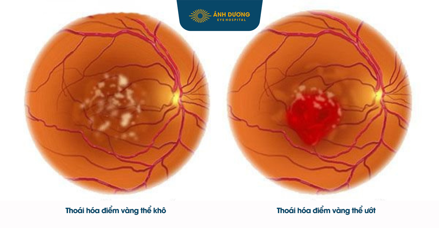 Bệnh hoàng điểm – Nguyên nhân, triệu chứng và cách điều trị
