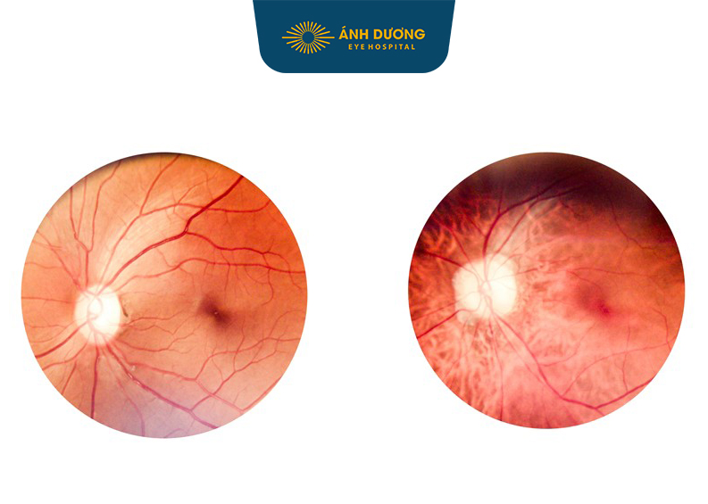 Các bệnh về dịch kính võng mạc – Nguyên nhân, triệu chứng và cách điều trị