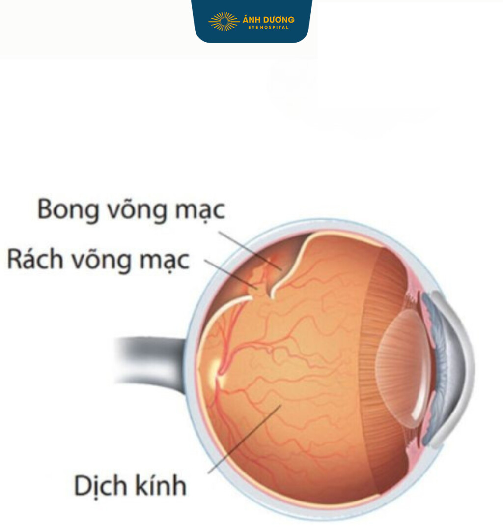 Dịch kính – Bộ phận quan trọng quyết định thị lực của mắt