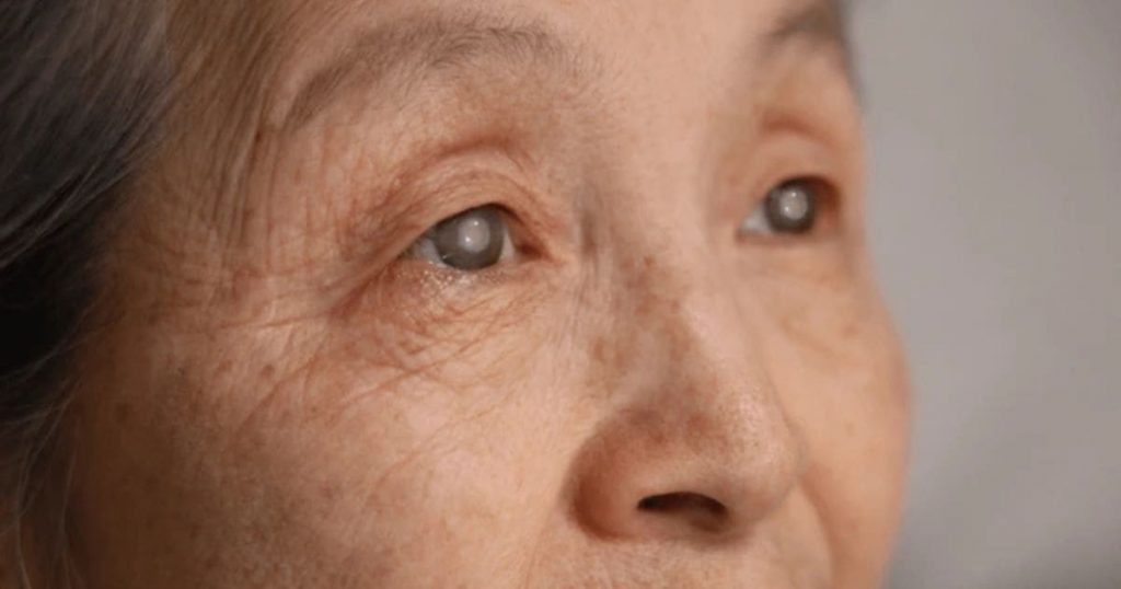 Đục thể thủy tinh tuổi già – Nguyên nhân hàng đầu gây mù lòa ở người cao tuổi