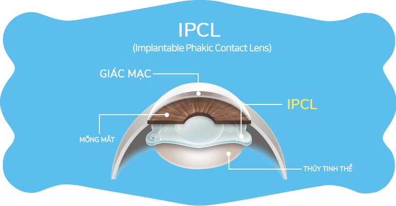 Phakic IPCL – Giải pháp hiện đại cho người cận thị nặng và giác mạc mỏng
