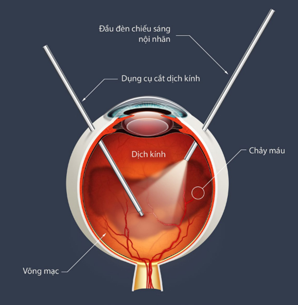 Phẫu thuật cắt dịch kính – Giải pháp điều trị bệnh lý võng mạc