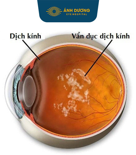 Vẩn đục Dịch Kính