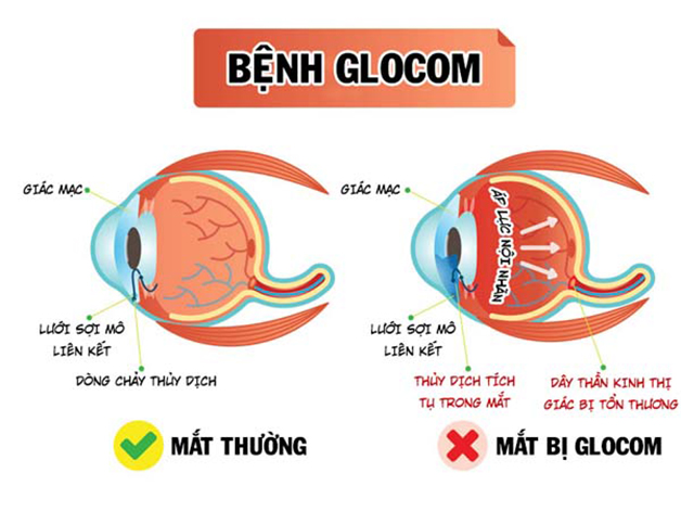 Bệnh Glôcôm là gì? Những ai có nguy cơ cao mắc Glôcôm và cần tầm soát sớm