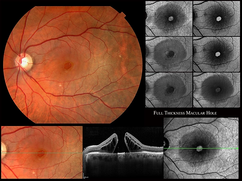 Lỗ hoàng điểm – Bệnh lý mắt nguy hiểm không thể bỏ qua