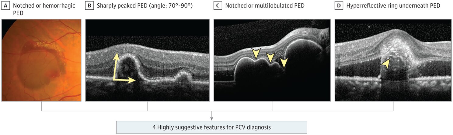 Bệnh lý Polyp mạch hắc mạc – Triệu chứng, nguyên nhân và cách điều trị
