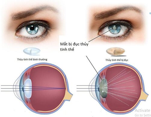 Đục thủy tinh thể là gì? Nguyên nhân, dấu hiệu và ảnh hưởng đến thị lực người trung niên – cao tuổi