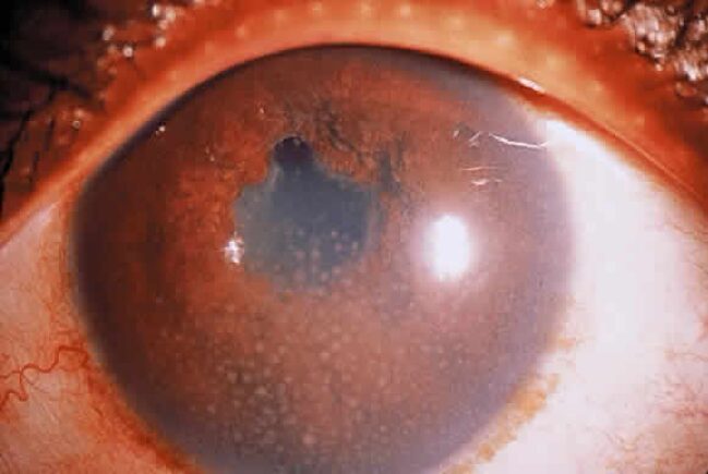 Chẩn Đoán Và Điều Trị Viêm Màng Bồ Đào: Những Điều Người Bệnh Cần Biết