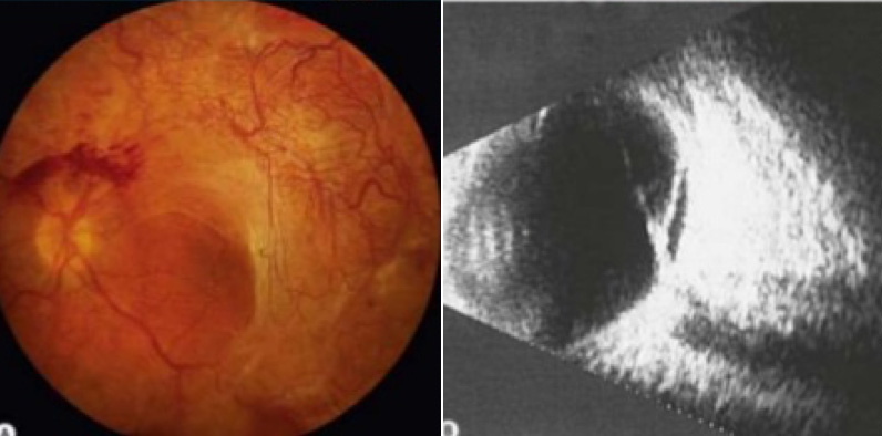 Bệnh võng mạc đái tháo đường – Tất cả những điều cần biết