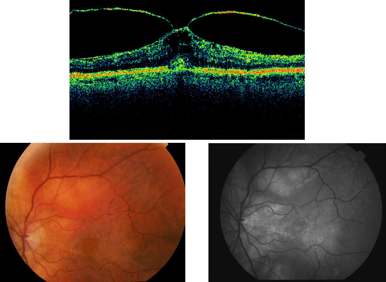Tìm hiểu về bệnh màng trước võng mạc