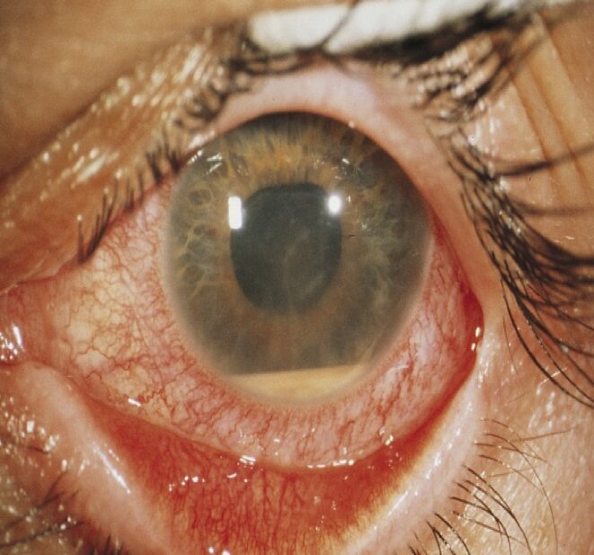 Tầm Quan Trọng Của Viêm Màng Bồ Đào Đối Với Thị Lực