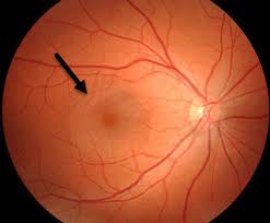 BỆNH HẮC VÕNG MẠC TRUNG TÂM THANH DỊCH