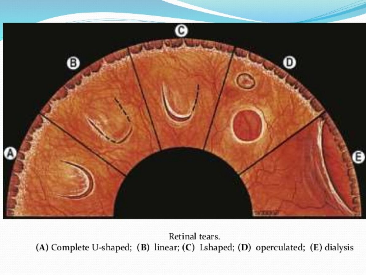 Rách võng mạc là gì? Dấu hiệu và cách điều trị