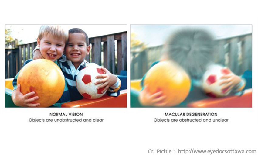 THOÁI HOÁ HOÀNG ĐIỂM TUỔI GIÀ – Tổng hợp thông tin từ A-Z