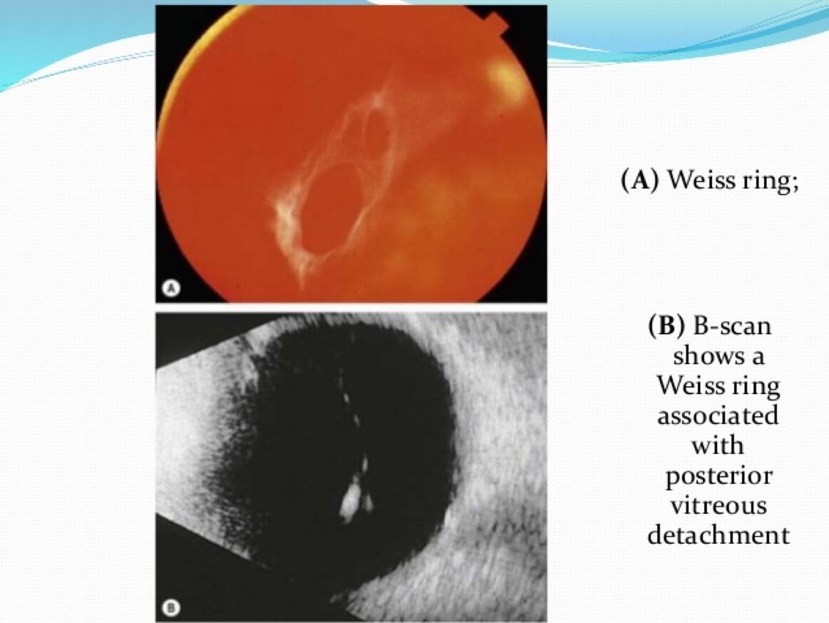 Vẩn đục dịch kính: dấu hiệu bình thường hay nguy hiểm?