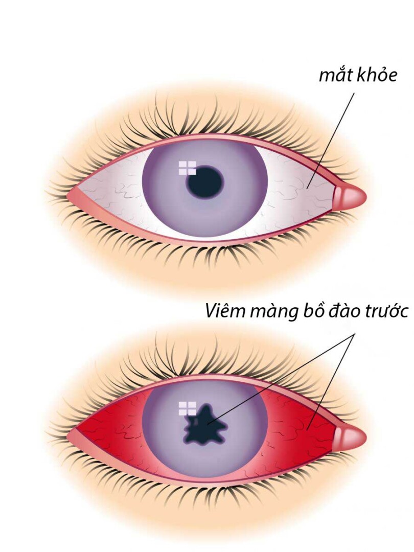 Viêm Màng Bồ Đào Là Gì? Dấu Hiệu Nhận Biết Sớm Không Nên Bỏ Qua