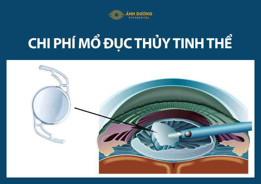 Chi phí mổ đục thủy tinh thể 2026: Bảng giá chi tiết và quyền lợi BHYT