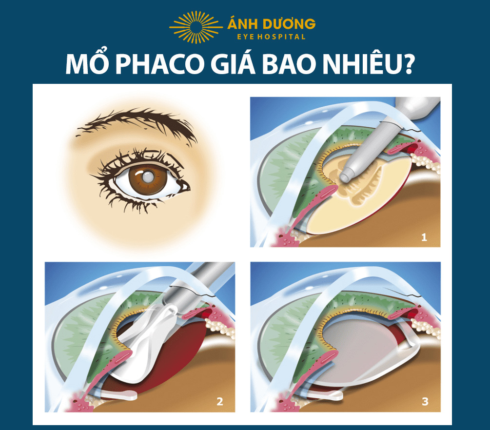 Mổ Phaco Giá Bao Nhiêu 2026? Cập Nhật Bảng Giá Ưu Đãi & Quà Tặng Tại Bệnh Viện Mắt Ánh Dương