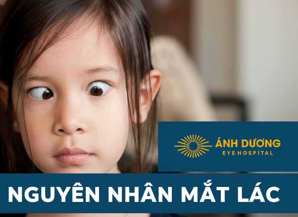 Nguyên Nhân Mắt Lác: Hiểu Đúng Để Điều Trị Kịp Thời