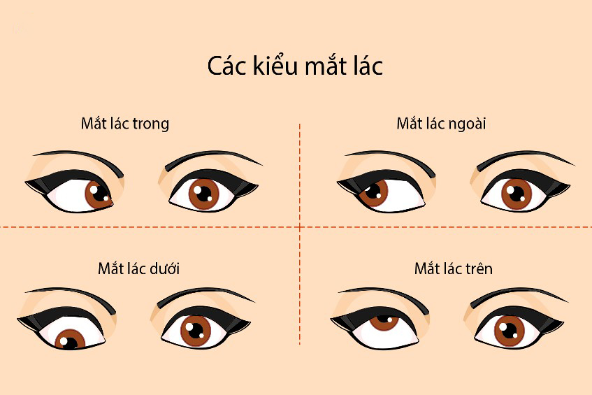 Mắt lác có tự khỏi không? Những sự thật bạn cần biết để bảo vệ đôi mắt
