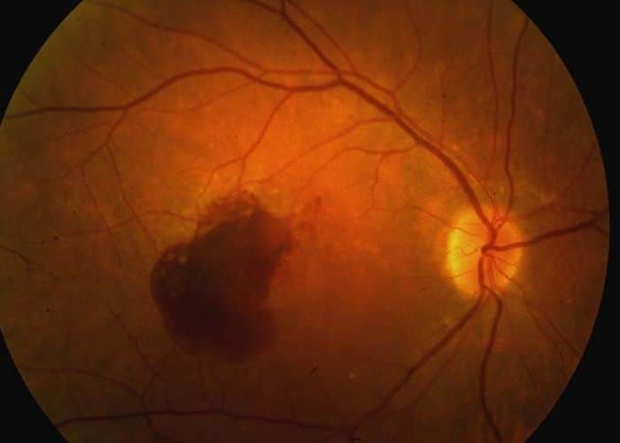 Điều Trị Thoái Hóa Hoàng Điểm Tuổi Già: Cập Nhật Y Khoa Mới Nhất 2026