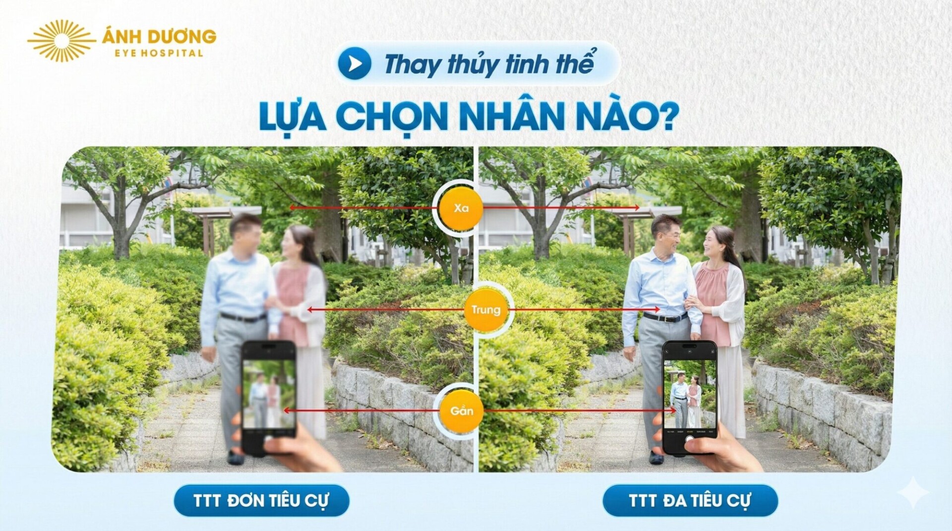 So sánh thể thủy tinh đơn tiêu và đa tiêu – Nên chọn loại nào khi thay thủy tinh thể?