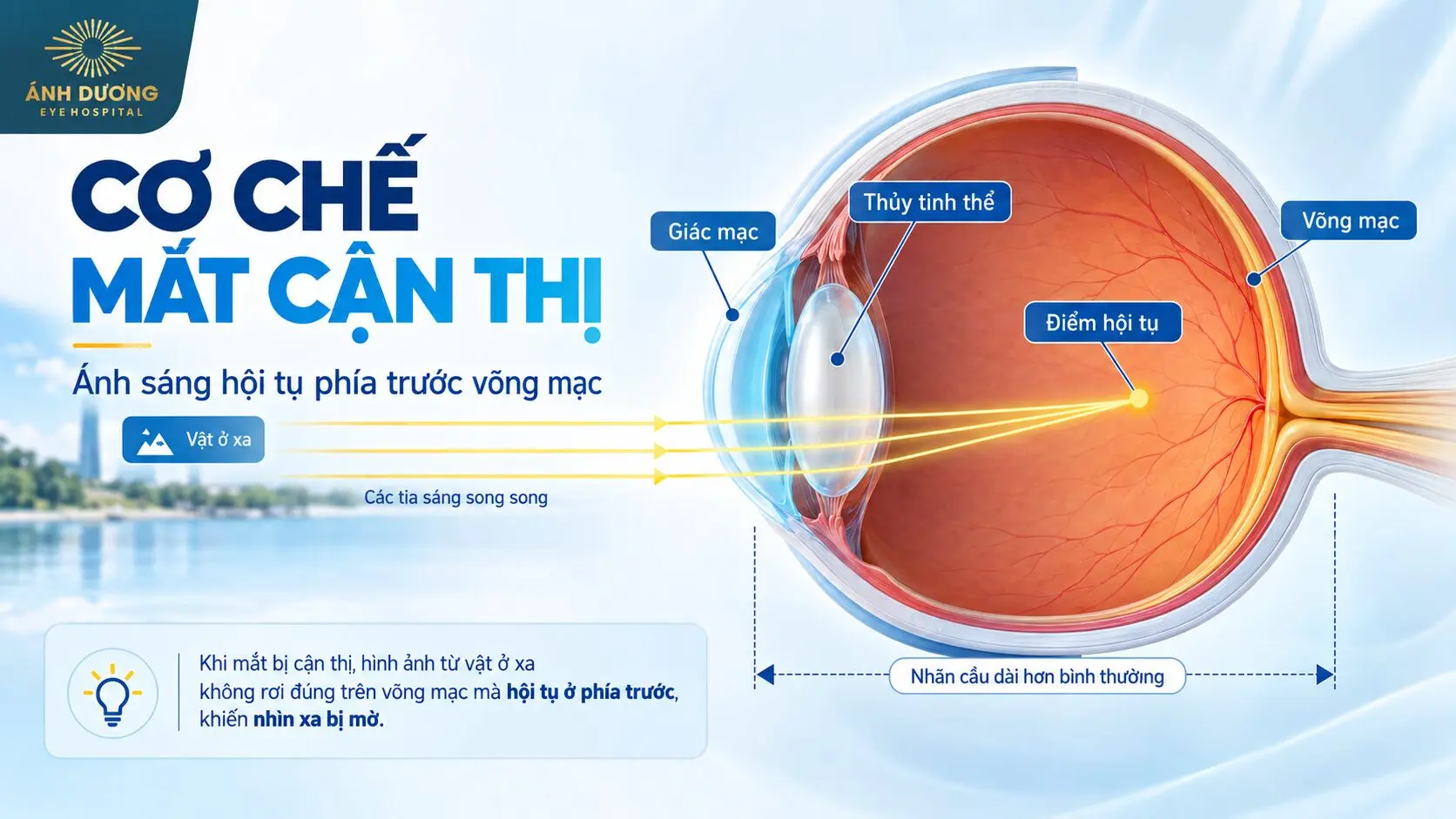Cơ chế mắt cận thị ánh sáng hội tụ trước võng mạc
