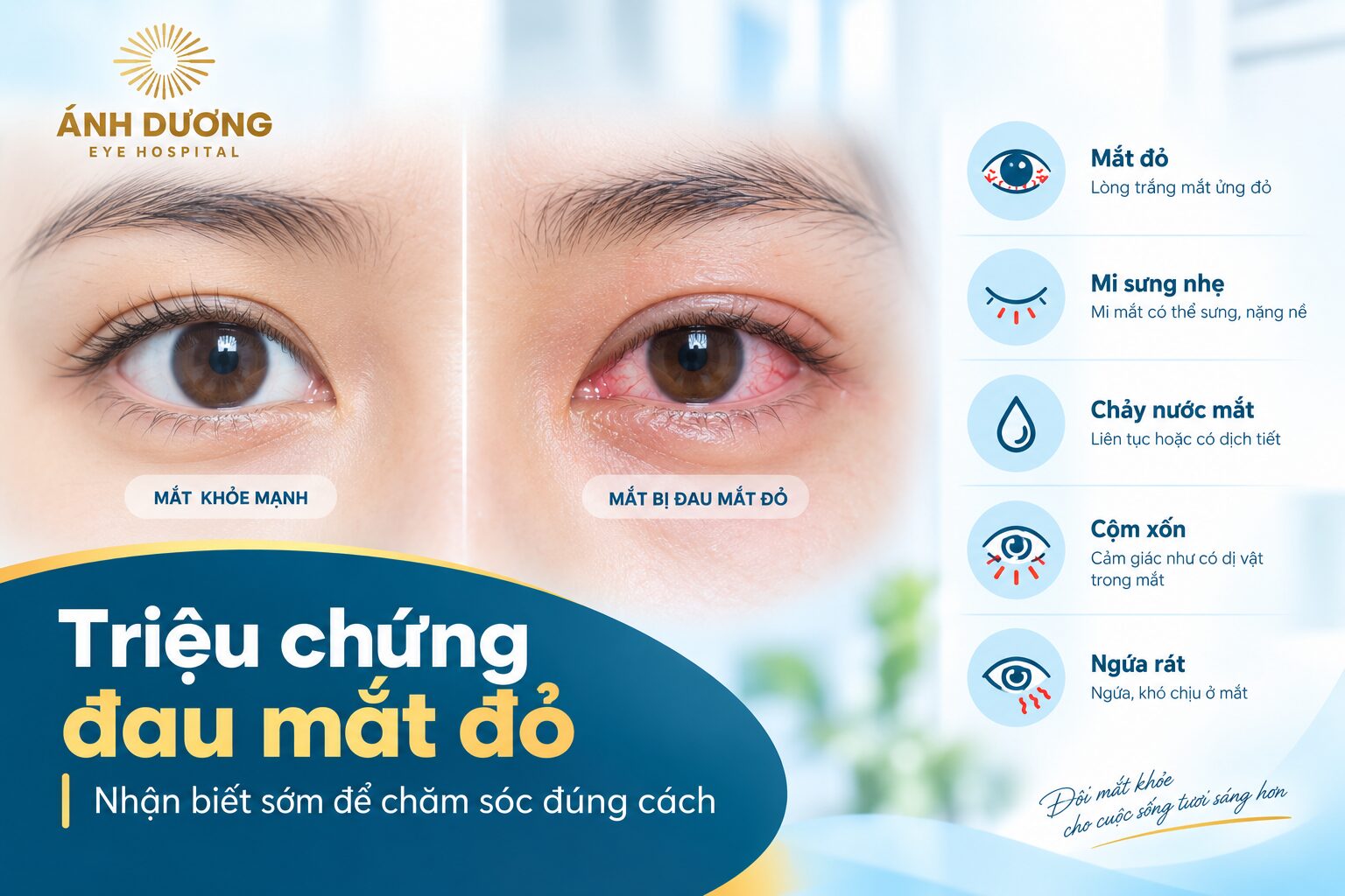 Hình ảnh triệu chứng đau mắt đỏ với lòng trắng mắt bị đỏ và mi mắt sưng